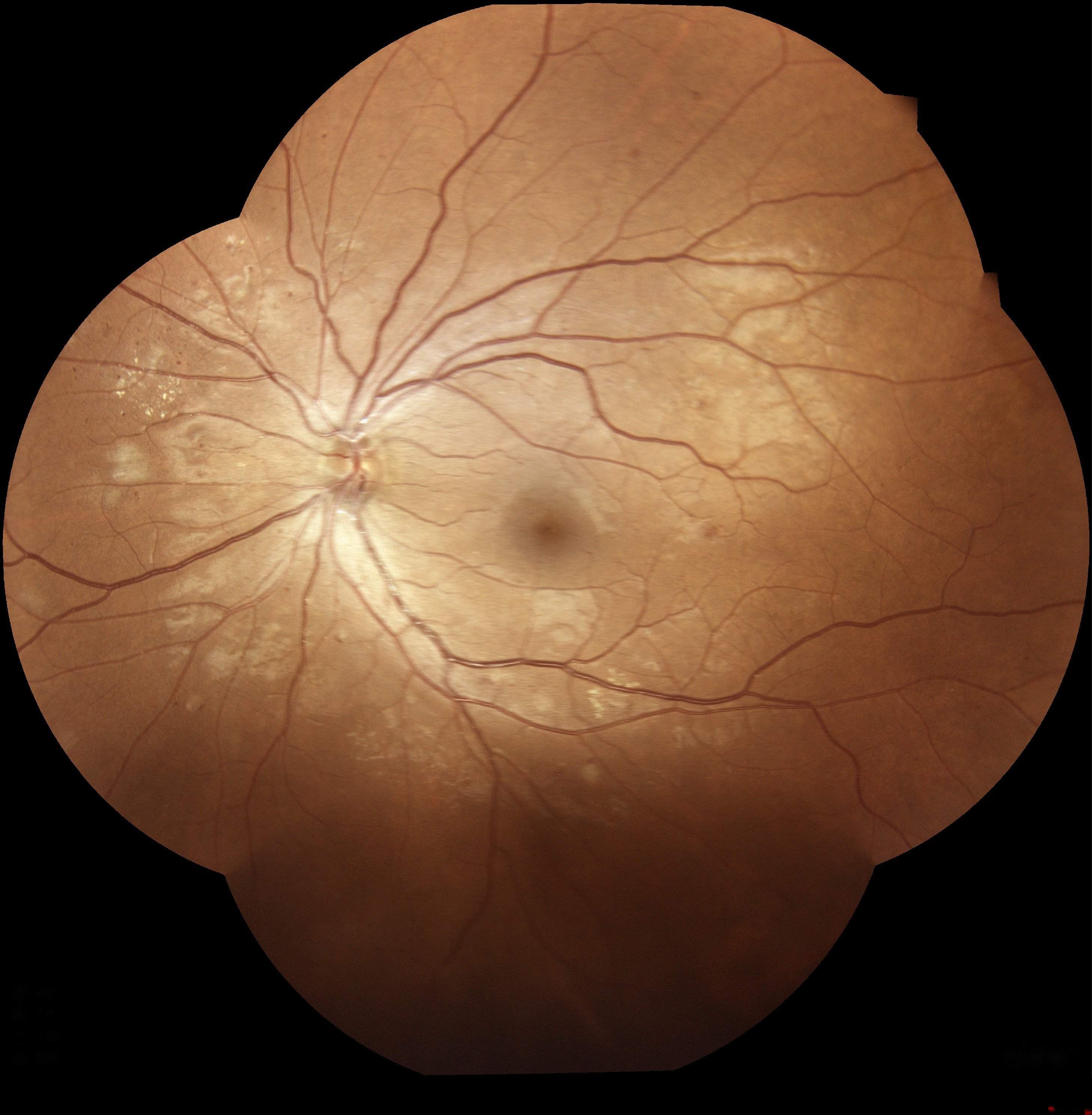 Deep Learning-Based Diabetic Retinopathy Detection in Fundus Images